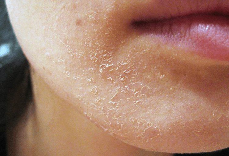Một tác dụng không mong muốn khác của retinol đó chính là khiến da khô và bong tóc