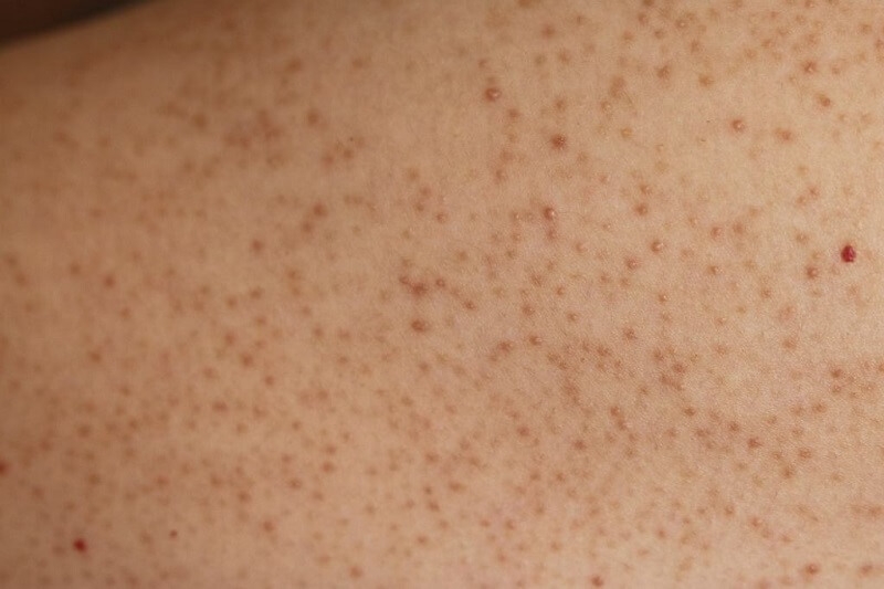 cách trị viêm nang lông bằng muối tại nhà