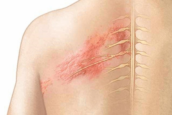 Triệu chứng bệnh Zona thần kinh
