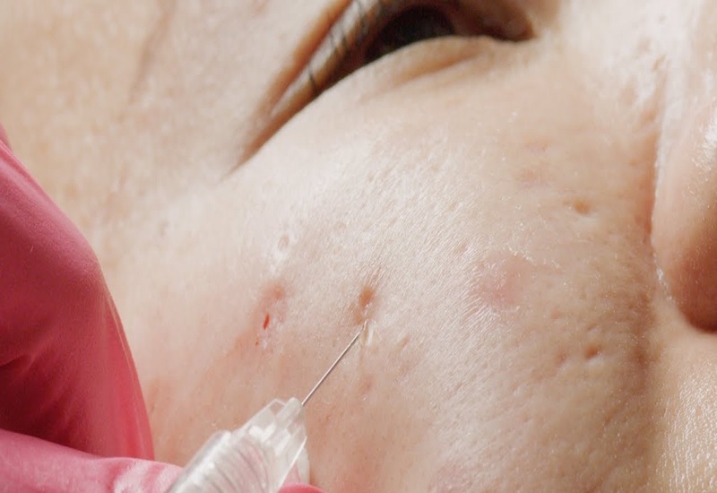 Tiêm filler cũng có tác dụng trong điều trị sẹo rỗ