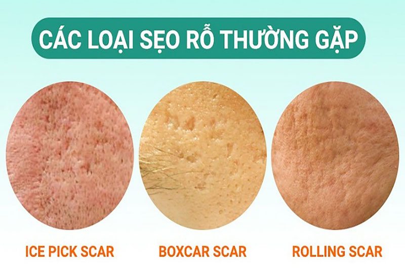 Từ trái qua phải: sẹo rỗ chân đá nhọn, sẹo rỗ chân vuông, sẹo rỗ hình lượn sóng