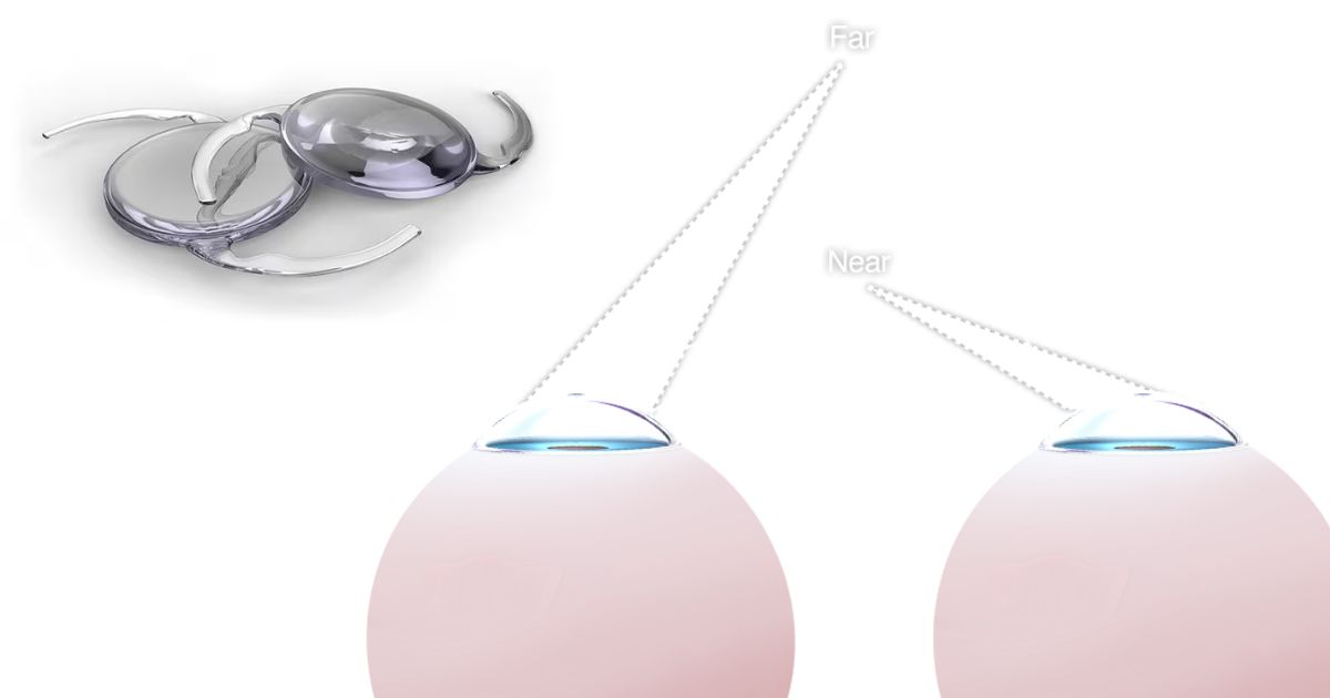 Monovision là thấu kính đặc biệt, hỗ trợ người bệnh nhìn cả ở cự ly xa và gần 