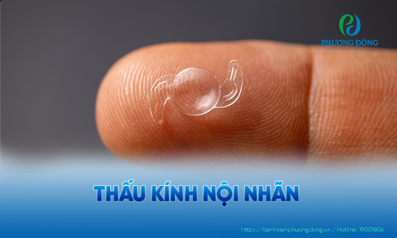 IOL là thấu kính nhân tạo, hỗ trợ hội tụ ánh sáng chính xác hơn 