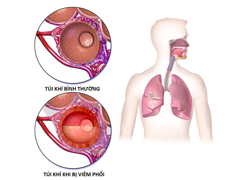 khó thở là bệnh gì