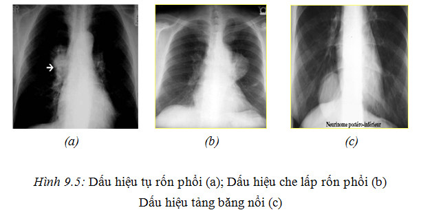 Các phương pháp XQuang lồng ngực