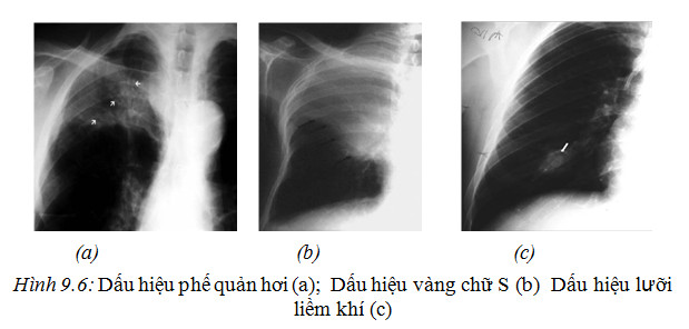 Các phương pháp XQuang lồng ngực
