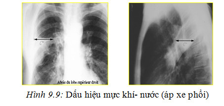 Các phương pháp XQuang lồng ngực