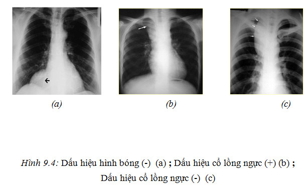 Các phương pháp XQuang lồng ngực