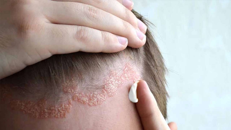 Nguyên nhân gây ngứa da đầu và cách khắc phục với dầu gội Nazorel 2