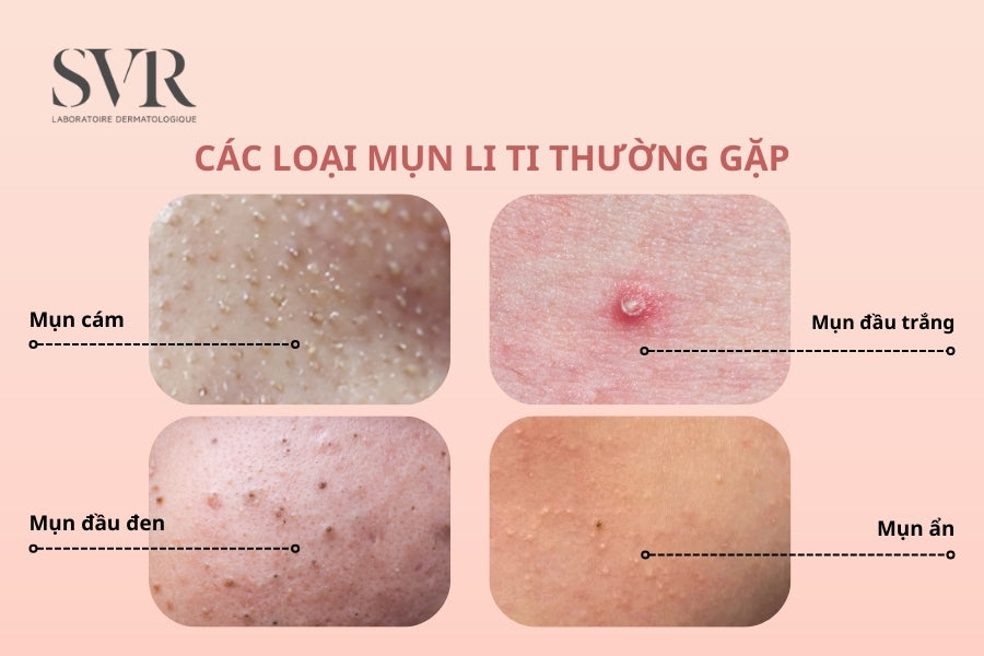 Các loại mụn li ti thường gặp