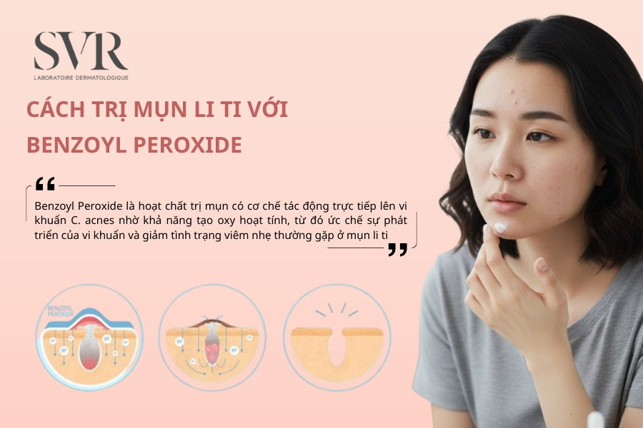 Cách trị mụn li ti bằng Benzoyl Peroxide