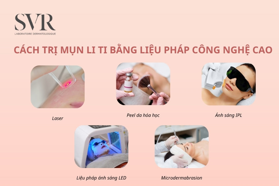 Cách trị mụn li ti bằng liệu pháp công nghệ cao