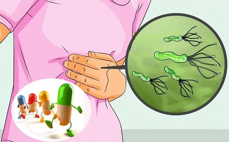Thuốc kháng histamin H2 được dùng để điều trị bệnh gì? 5